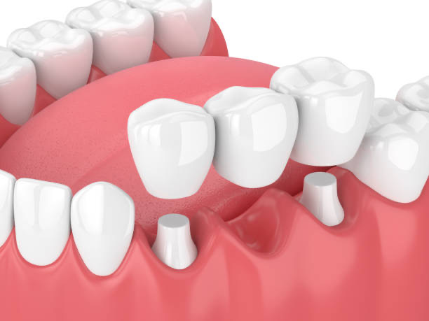 3d render of jaw with dental bridge  over white background